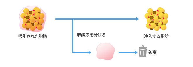 従来の脂肪注入