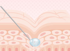 シワに沿ってヒアルロン酸を注入